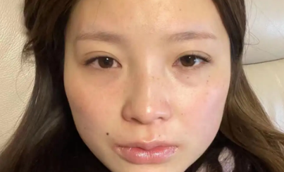 去眼袋手术
