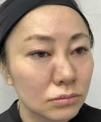 去眼袋手术