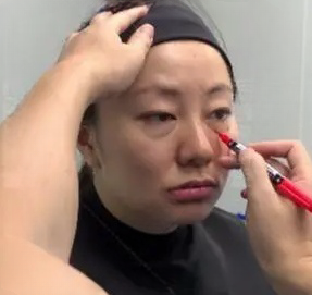 去眼袋手术