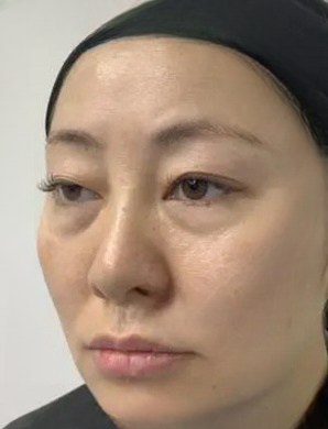 去眼袋手术