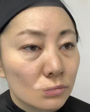 去眼袋手术