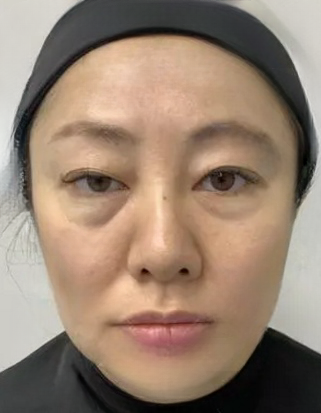 去眼袋手术