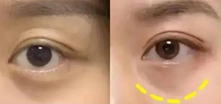 去眼袋手术