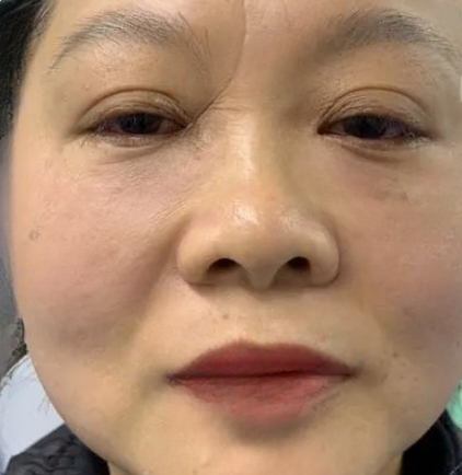 去眼袋手术