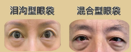 眼袋