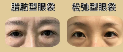 眼袋