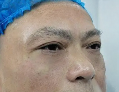 去眼袋手术