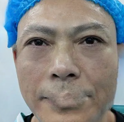 去眼袋手术