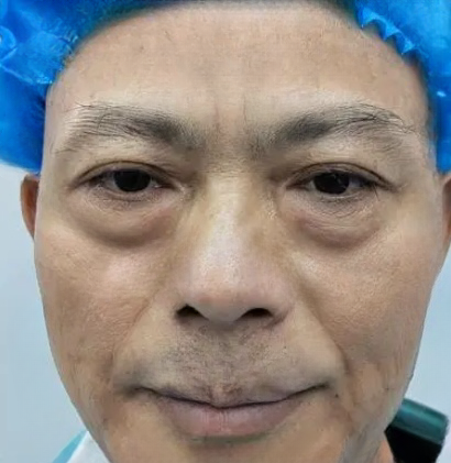 去眼袋手术