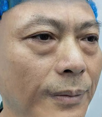 去眼袋手术