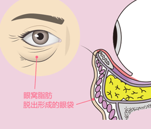 去眼袋手术