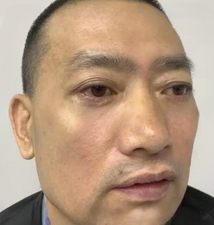 去眼袋手术