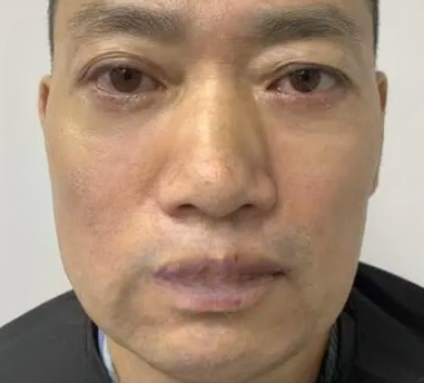 去眼袋手术