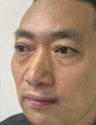 去眼袋手术