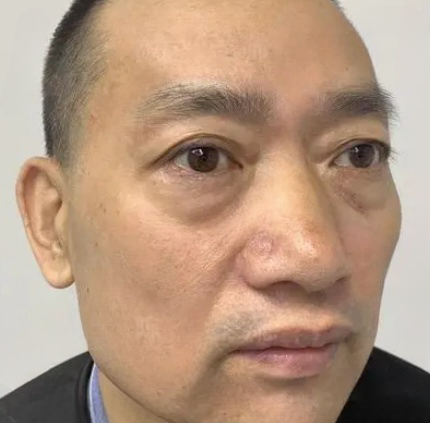 去眼袋手术