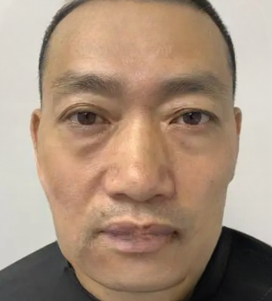 去眼袋手术