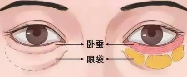 去眼袋手术
