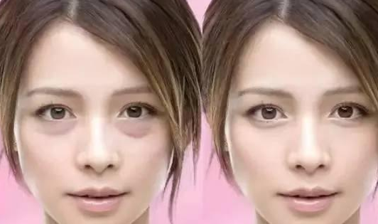 去眼袋手术