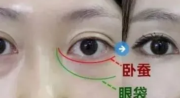 去眼袋手术
