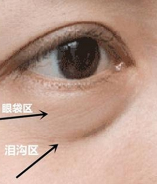 去眼袋手术
