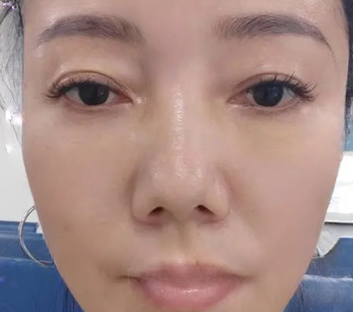 去眼袋手术