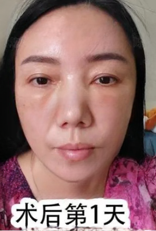 去眼袋手术