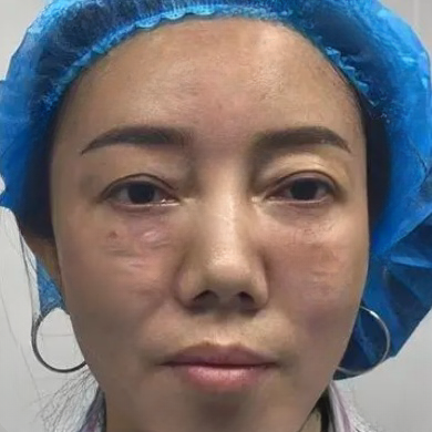 去眼袋手术