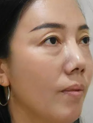 去眼袋手术