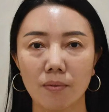 去眼袋手术