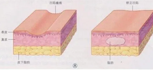 自体脂肪填充