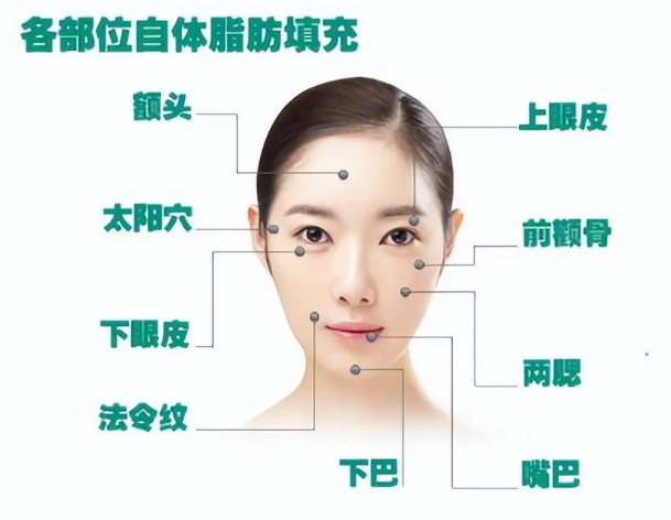 自体脂肪填充