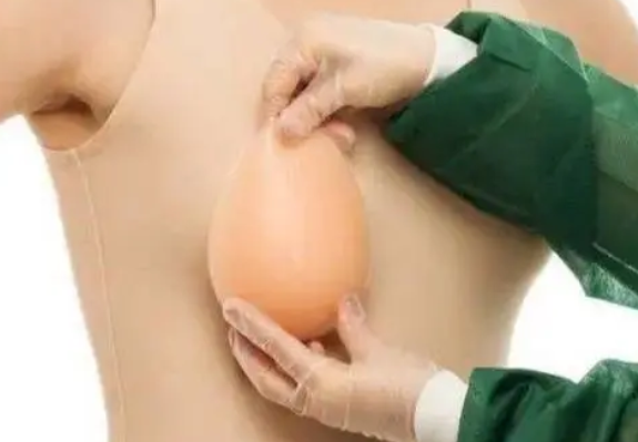 自体脂肪丰胸
