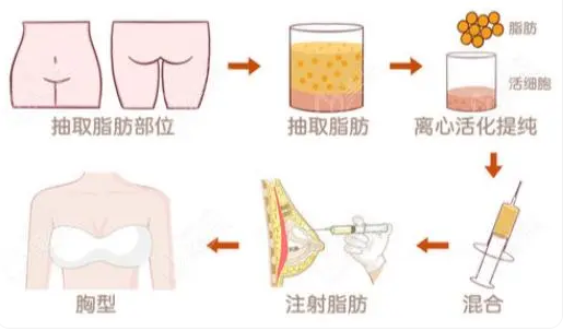 自体脂肪丰胸