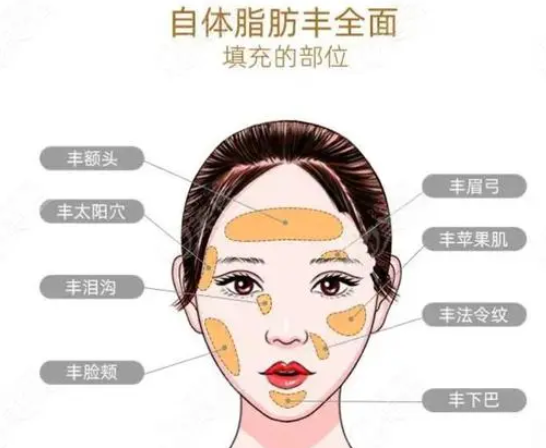 自体脂肪填充