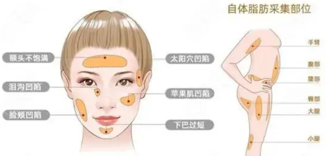 自体脂肪填充