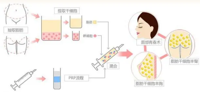 自体脂肪填充