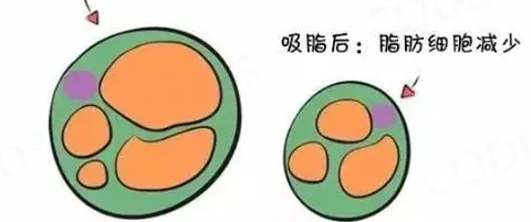 超声波减肥