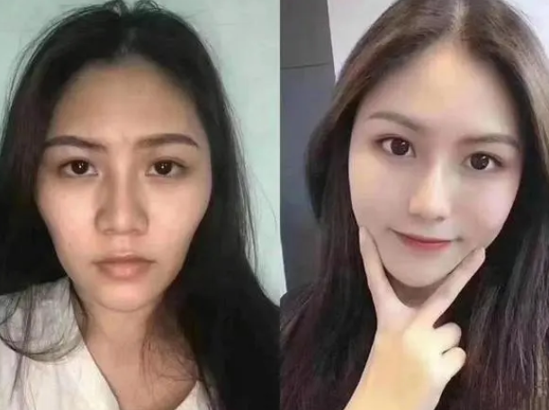 自体脂肪填充