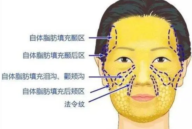 自体脂肪填充