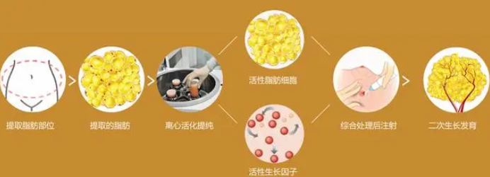 自体脂肪填充