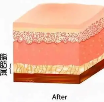 自体脂肪填充