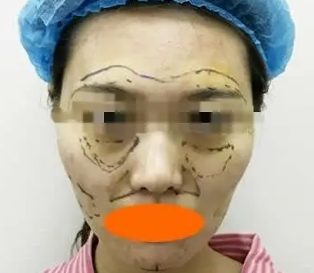 自体脂肪填充