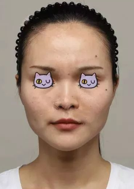 自体脂肪填充