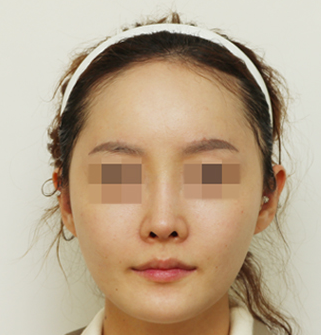 自体脂肪填充