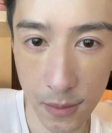 去眼袋手术