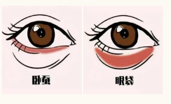 去眼袋手术