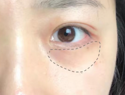 去眼袋手术