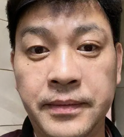 去眼袋手术
