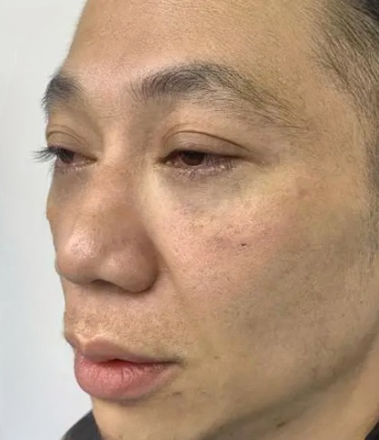 去眼袋手术