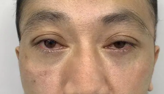 去眼袋手术